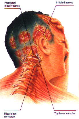 best of Facial nerve headache Inflamed