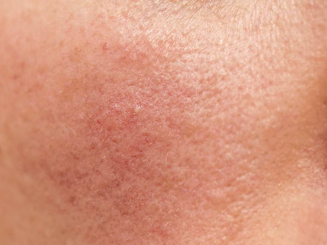 Brambleberry reccomend Bumps on face after sex