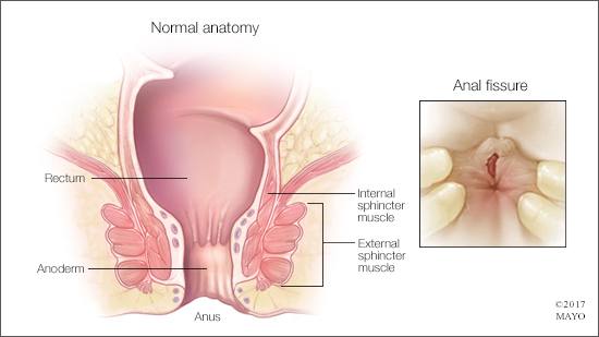 best of Anal fissures Prevent