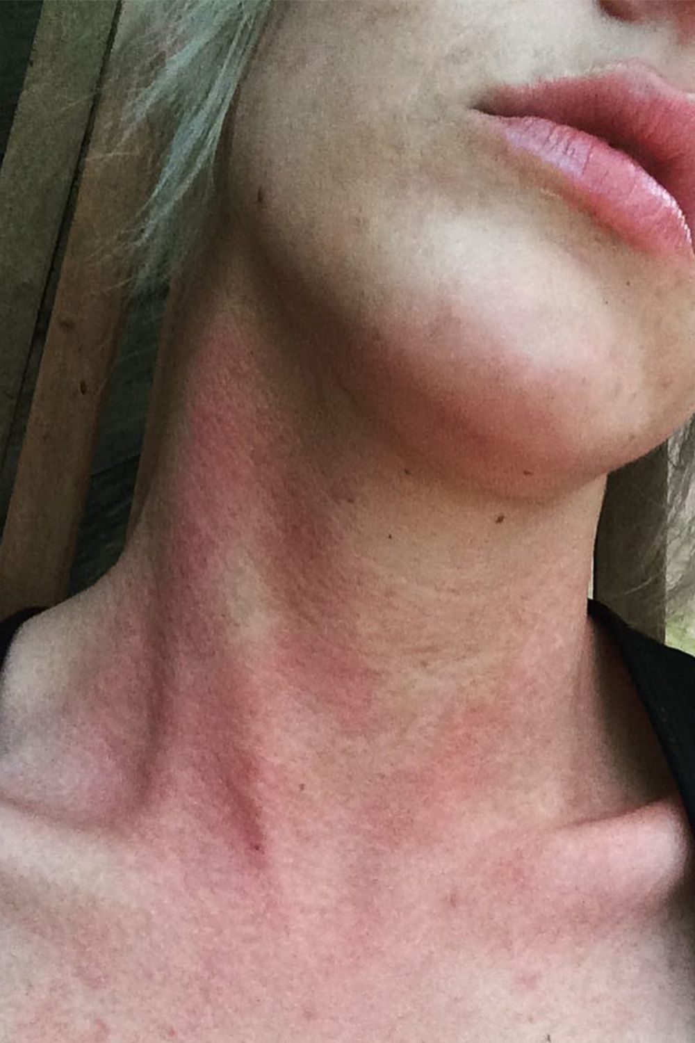 Power S. reccomend Bumps on face after sex