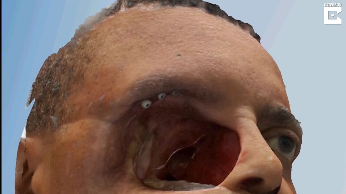 Facial tissue transplant