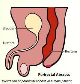 Lump adjacent to anus