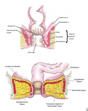 Seton in anus