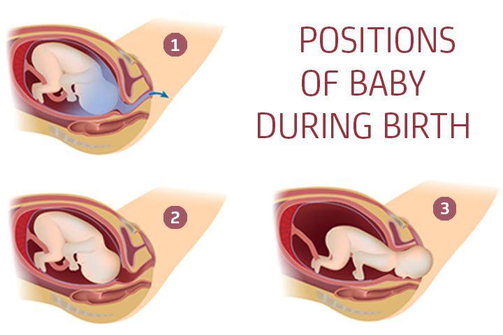 The ideal position of a fetus for a vaginal delivery